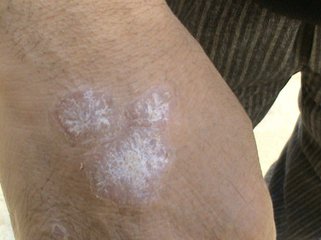 治疗银屑病的最新方法,治疗银屑病的最新方法